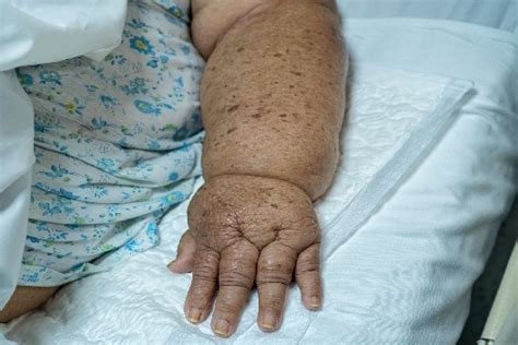 lymphœdème du bras photos|Lymphoedème : Symptômes, Risques, Traitements